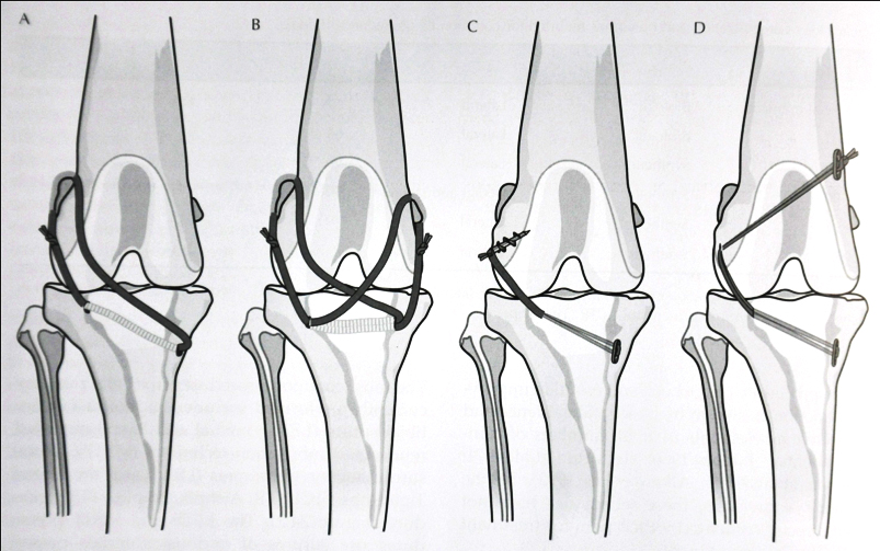 Tecniche Extracapsulari